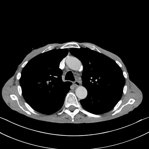 File:Acquired tracheoesophageal fistula (Radiopaedia 57747-65042 Axial C+ portal venous phase 33).jpg