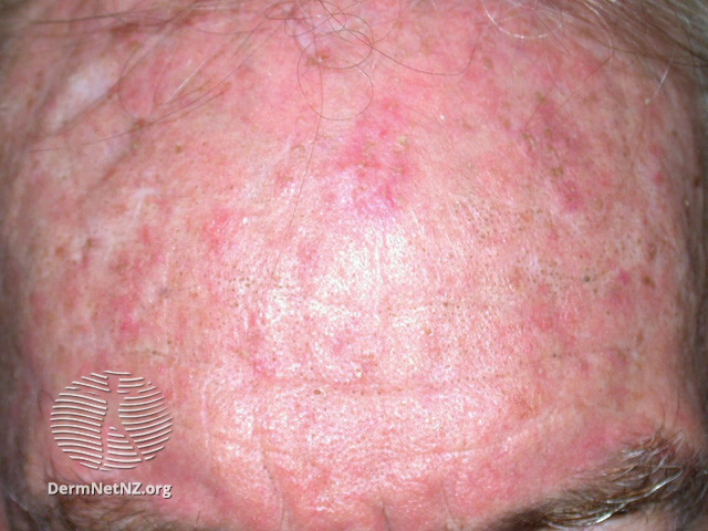 Actinic Keratoses affecting the face (DermNet NZ lesions-ak-face-512).jpg