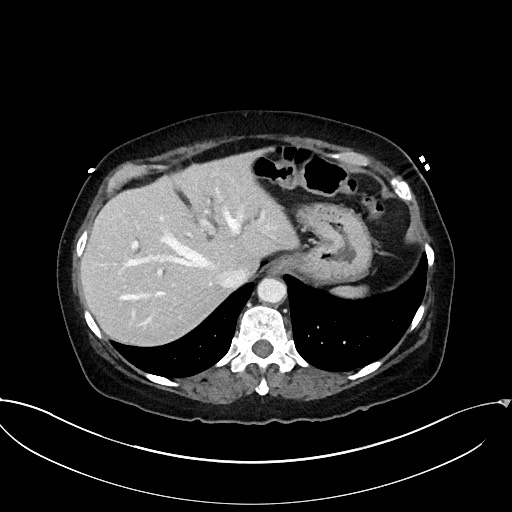 Active Crohn disease (Radiopaedia 59394-66750 Axial C+ portal venous phase 14).jpg