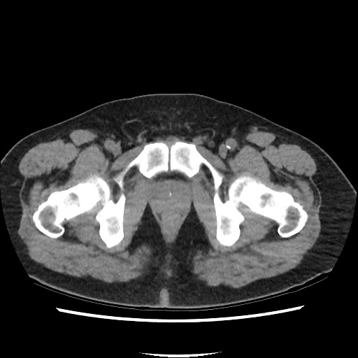 Active colonic bleed on CT (Radiopaedia 49765-55025 Axial non-contrast 84).jpg