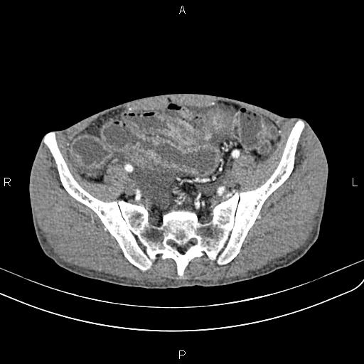 Active crohn disease (Radiopaedia 87133-103397 Axial C+ arterial phase 81).jpg