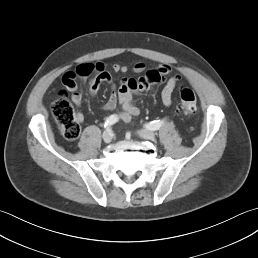 File:Active diverticular hemorrhage (Radiopaedia 39415-41725 Axial C+ portal venous phase 47).png