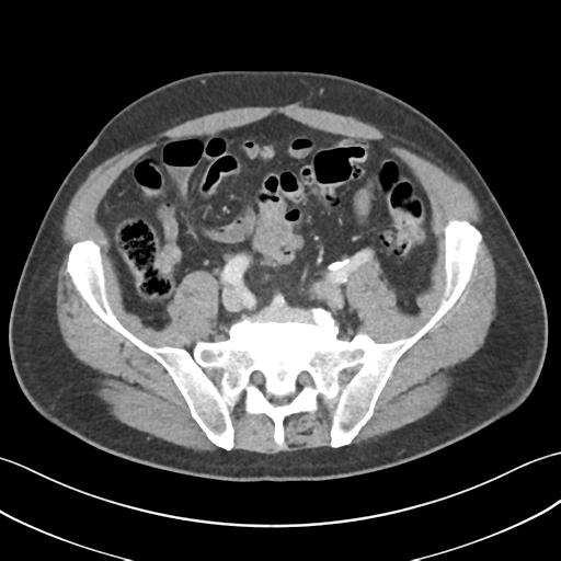 File:Active diverticular hemorrhage (Radiopaedia 39415-41725 Axial C+ portal venous phase 48).png
