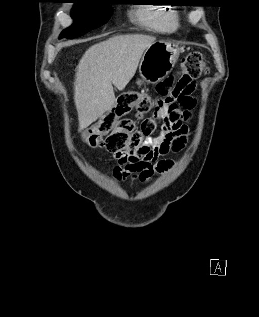 Active lower gastrointestinal bleeding - diverticular (Radiopaedia 61203-69106 Coronal C+ portal venous phase 22).jpg