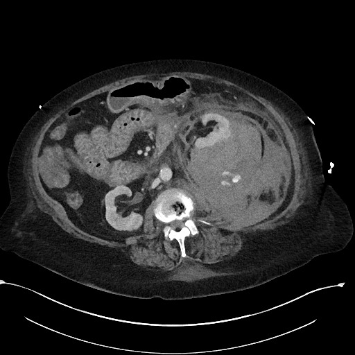 File:Active renal extravasation with large subcapsular and retroperitoneal hemorrhage (Radiopaedia 60975-68796 Axial 253).jpg