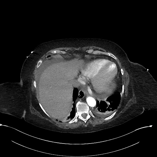 Active renal extravasation with large subcapsular and retroperitoneal hemorrhage (Radiopaedia 60975-68796 Axial C+ arterial phase 27).jpg
