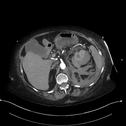 File:Active renal extravasation with large subcapsular and retroperitoneal hemorrhage (Radiopaedia 60975-68796 Axial C+ arterial phase 64).jpg