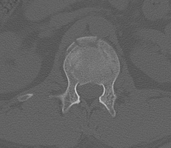 File:Acute L1 burst compression fracture (Radiopaedia 34430-35755 Axial bone window 20).png