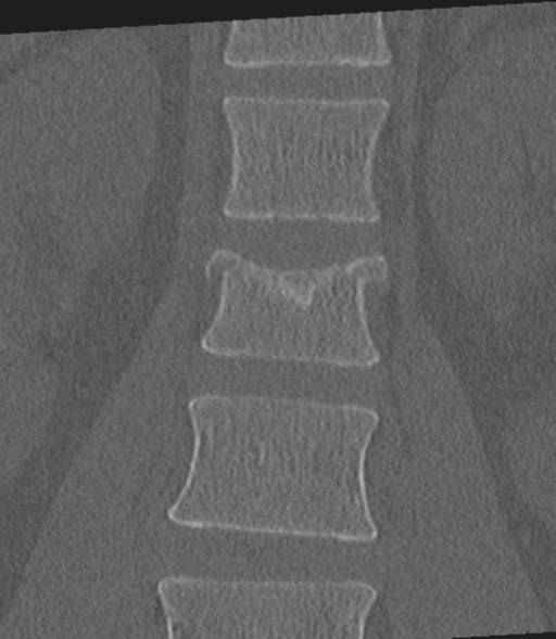 Acute L1 burst compression fracture (Radiopaedia 34430-35755 Coronal bone window 19).png
