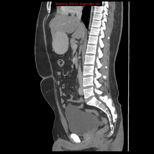 File:Acute appendicitis (Radiopaedia 10498-10973 Sagittal C+ portal venous phase 29).jpg