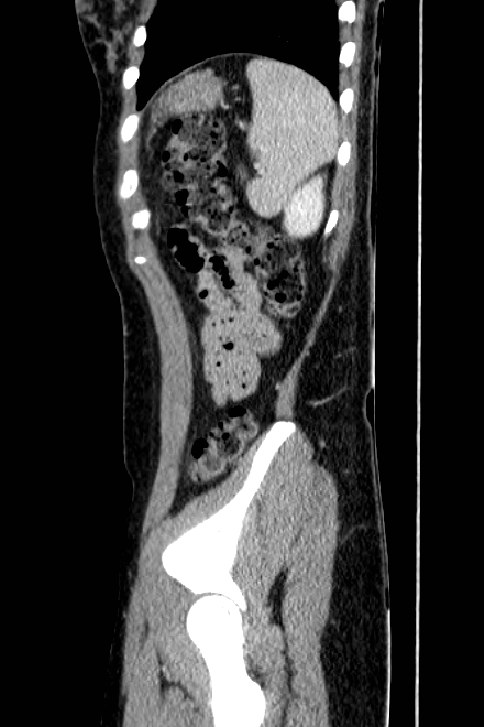 Acute appendicitis (Radiopaedia 22892-22918 Sagittal C+ portal venous phase 74).png