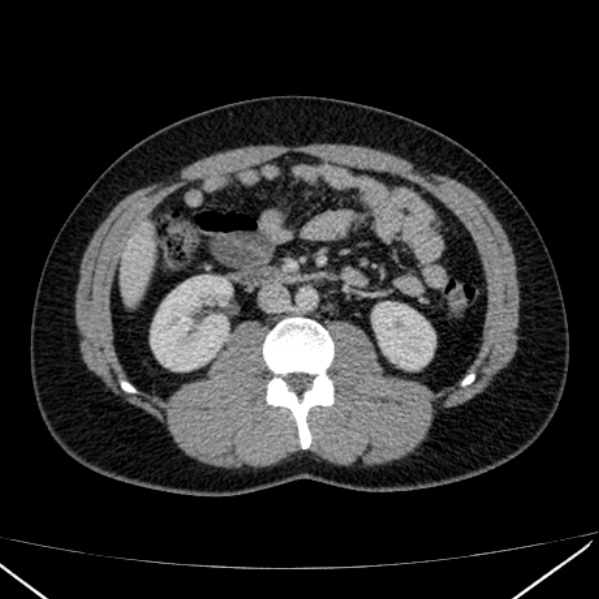 Acute appendicitis (Radiopaedia 38255-40270 Axial C+ portal venous phase 48).jpg