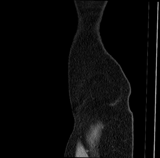 Acute appendicitis (Radiopaedia 38255-40270 Sagittal C+ portal venous phase 85).jpg