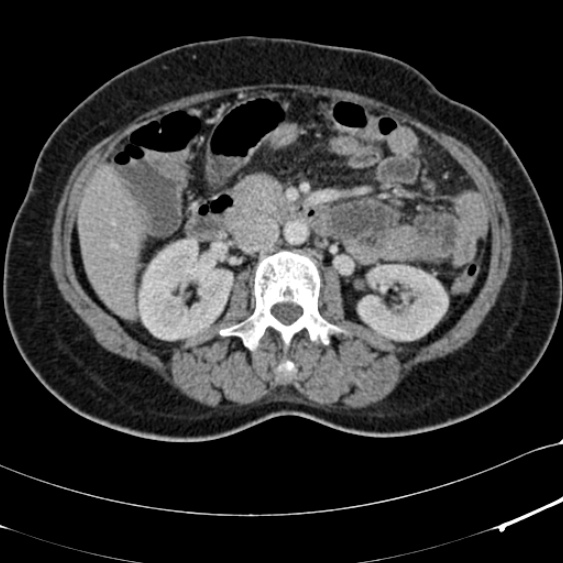 Acute appendicitis (Radiopaedia 48792-53822 Axial C+ portal venous phase 48).jpg