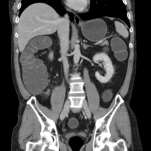 Acute appendicitis (Radiopaedia 66513-75790 Coronal C+ portal venous phase 46).jpg