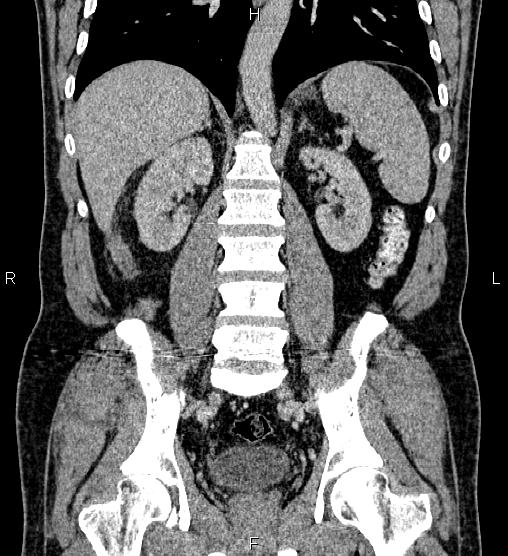 Acute appendicitis (Radiopaedia 84780-100240 Coronal C+ portal venous phase 53).jpg