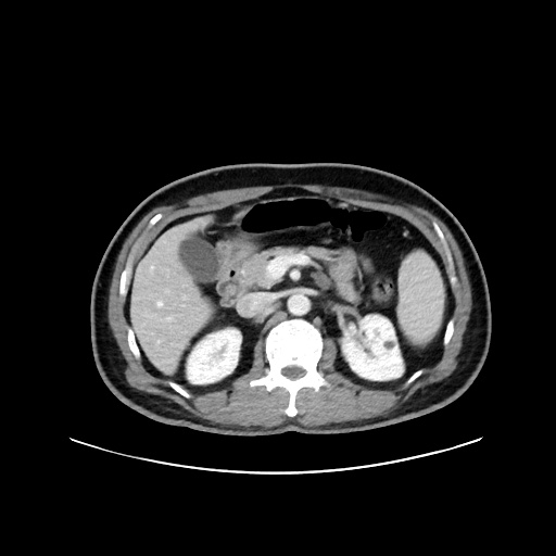 Acute appendicitis and COVID 19 pneumonia (Radiopaedia 76604-88380 Axial C+ portal venous phase 28).jpg