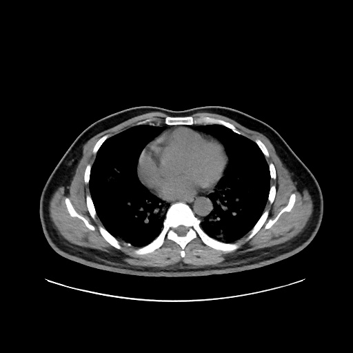 Acute appendicitis and COVID 19 pneumonia (Radiopaedia 76604-88380 Axial non-contrast 32).jpg
