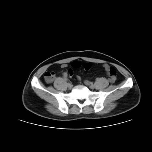 Acute appendicitis and COVID 19 pneumonia (Radiopaedia 76604-88380 Axial non-contrast 98).jpg