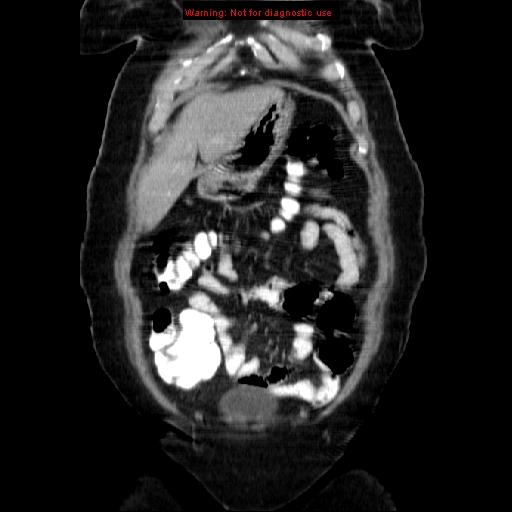 Acute appendicitis complicated by ovarian vein thrombophlebitis (Radiopaedia 16172-15851 Coronal C+ portal venous phase 20).jpg