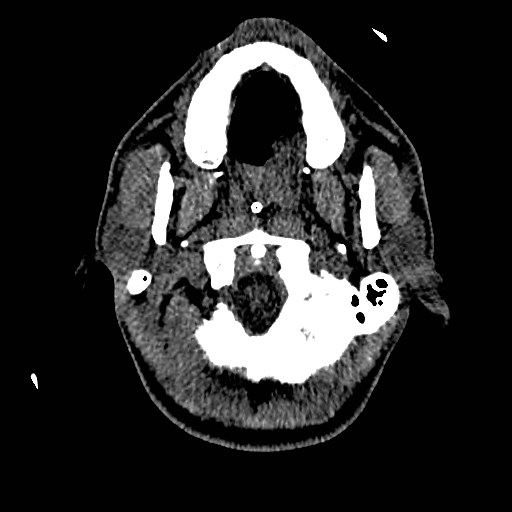 Acute basilar artery occlusion (Radiopaedia 43582-46985 Axial non-contrast 24).jpg
