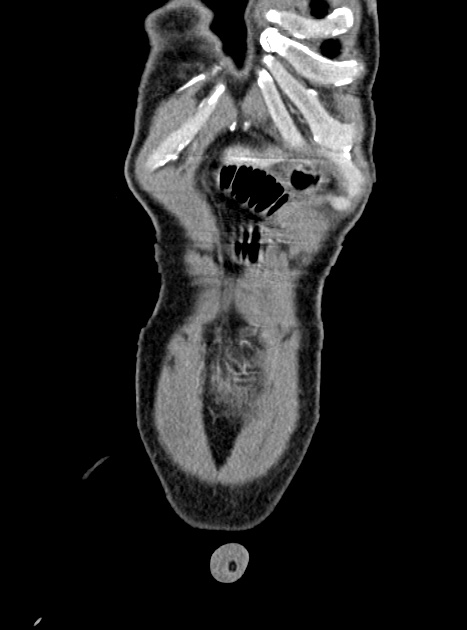 Acute bowel ischemia (Radiopaedia 87695-104114 Coronal C+ portal venous phase 74).jpg