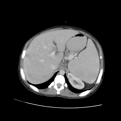 Acute calculous cholecystitis in patient with osteopetrosis (Radiopaedia 77871-90159 Axial C+ portal venous phase 26).jpg
