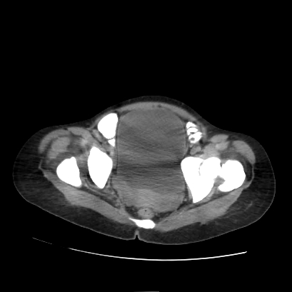 File:Acute calculous cholecystitis in patient with osteopetrosis (Radiopaedia 77871-90159 Axial non-contrast 72).jpg