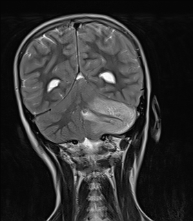 File:Acute cerebellar ataxia (Radiopaedia 61487-69446 Coronal T2 12).jpg