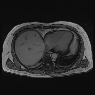 File:Acute cholecystitis (Radiopaedia 72392-82923 Axial T1 out-of-phase 23).jpg