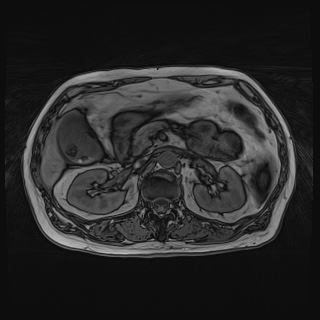 Acute cholecystitis (Radiopaedia 72392-82923 Axial T1 out-of-phase 58).jpg