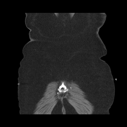 Acute cholecystitis with tensile fundus sign (Radiopaedia 71394-81723 Coronal non-contrast 114).jpg