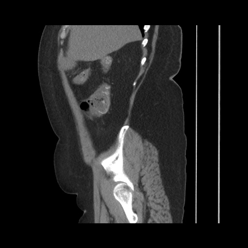 Acute cholecystitis with tensile fundus sign (Radiopaedia 71394-81723 Sagittal non-contrast 50).jpg