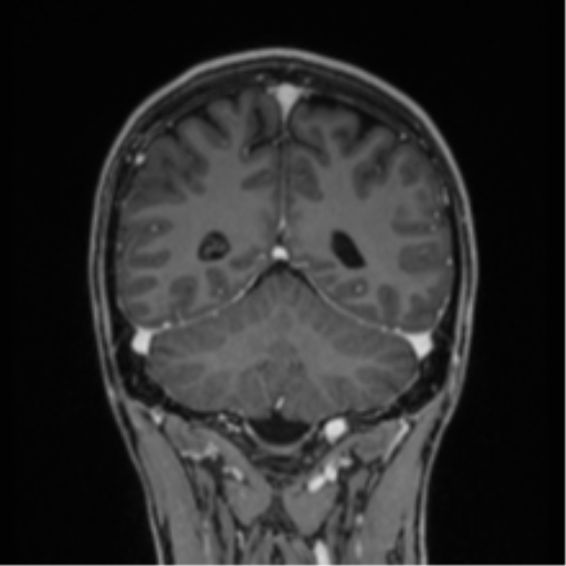 File:Acute disseminated encephalomyelitis (ADEM) (Radiopaedia 65319-74349 Coronal T1 C+ 5).png