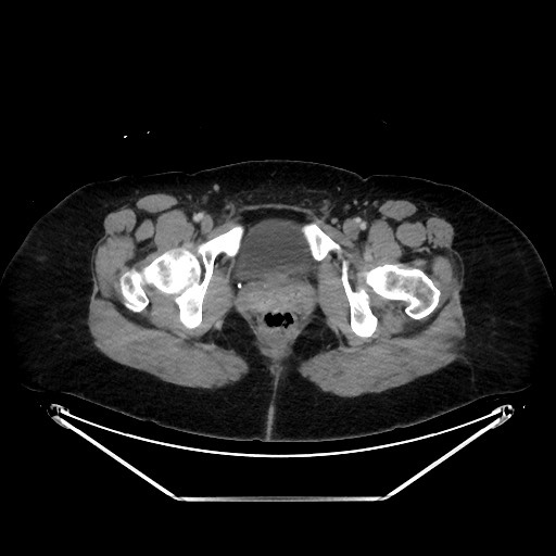 Acute diverticulitis - transverse colon (Radiopaedia 87063-103327 Axial C+ portal venous phase 165).jpg