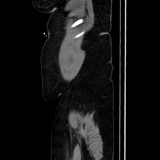Acute diverticulitis - transverse colon (Radiopaedia 87063-103327 Sagittal C+ portal venous phase 44).jpg