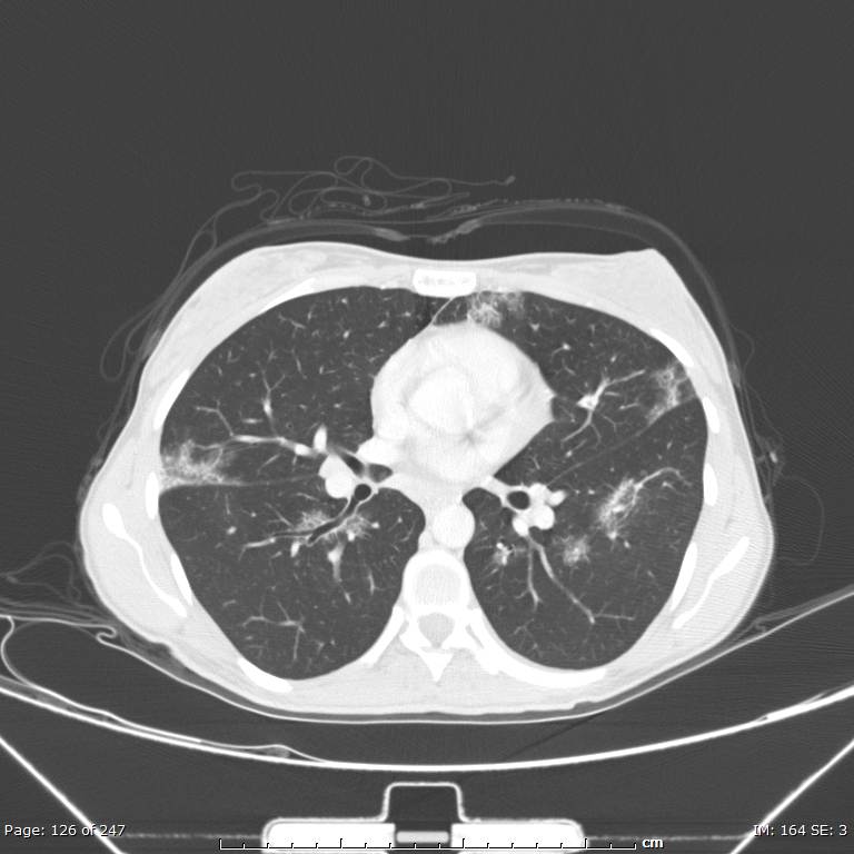 Acute eosinophilic pneumonia (Radiopaedia 48211-53073 Axial lung window 45).jpg