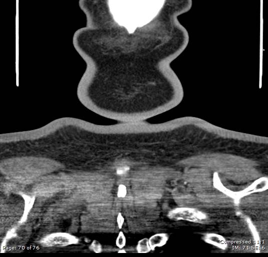 File:Acute epiglottitis (Radiopaedia 54375-60590 Coronal C+ arterial phase 70).jpg
