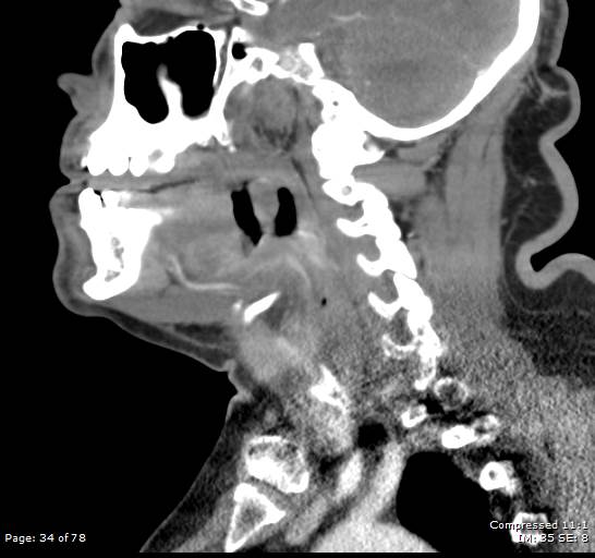 Acute epiglottitis (Radiopaedia 54375-60590 Sagittal C+ arterial phase 34).jpg