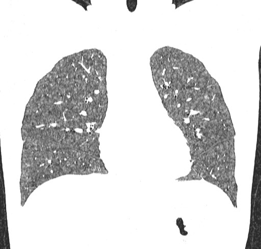 Acute hypersensitivity pneumonitis (Radiopaedia 85293-100870 Coronal lung window 46).jpg