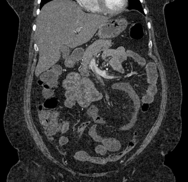Acute mesenteric ischemia (Radiopaedia 80029-93316 Coronal C+ arterial phase 50).jpg