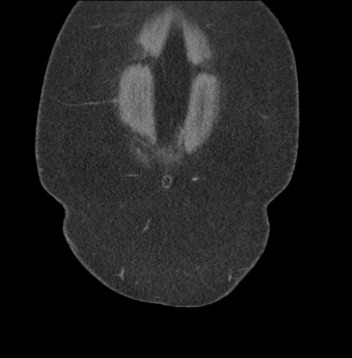 File:Acute mesenteric venous ischemia (Radiopaedia 46041-50383 Coronal C+ portal venous phase 7).jpg