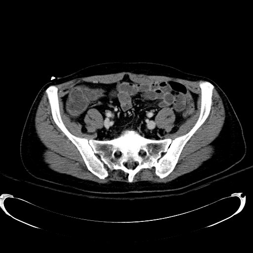 Acute myocardial infarction in CT (Radiopaedia 39947-42415 Axial C+ portal venous phase 97).jpg