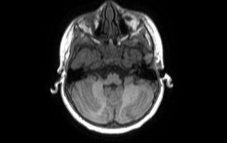 Acute necrotizing encephalitis of childhood (Radiopaedia 67356-76737 Axial T1 75).jpg