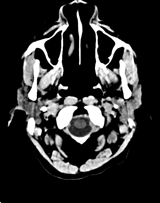 Acute on chronic subdural hematoma (Radiopaedia 74814-85823 Axial non-contrast 24).jpg