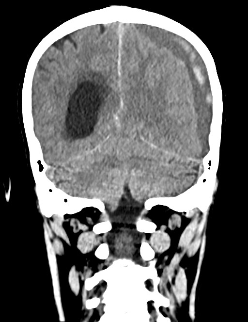 Acute on chronic subdural hematoma (Radiopaedia 74814-85823 Coronal non-contrast 46).jpg