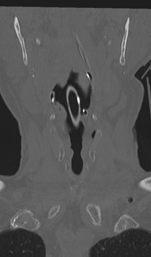 Acute on chronic subdural hematoma and thoracic vertebral injury in a multitrauma patient (Radiopaedia 31698-32619 Coronal bone window 3).jpg