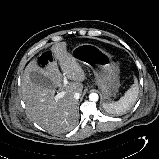 File:Acute pancreatic necrosis (Radiopaedia 13560-13486 Axial C+ portal venous phase 35).jpg