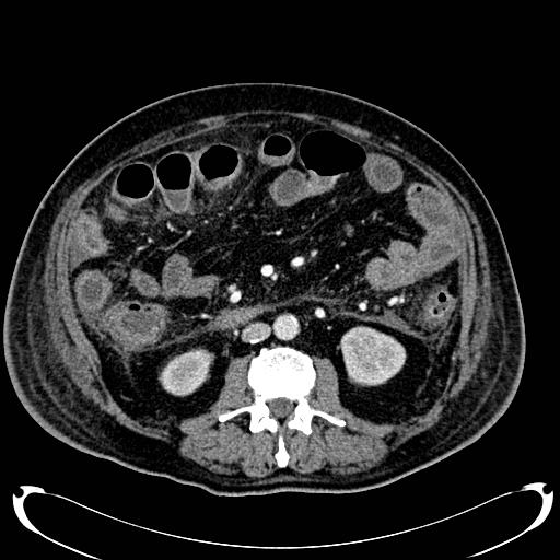 Acute pancreatic necrosis (Radiopaedia 13560-18500 Axial C+ portal venous phase 82).jpg