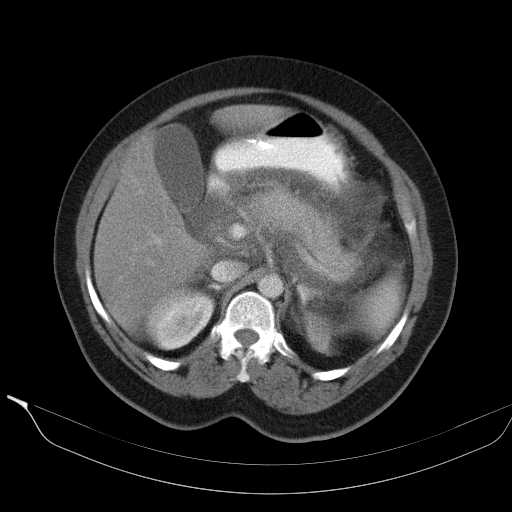 File:Acute pancreatitis (Radiopaedia 20829-20744 Axial C+ portal venous phase 16).jpg